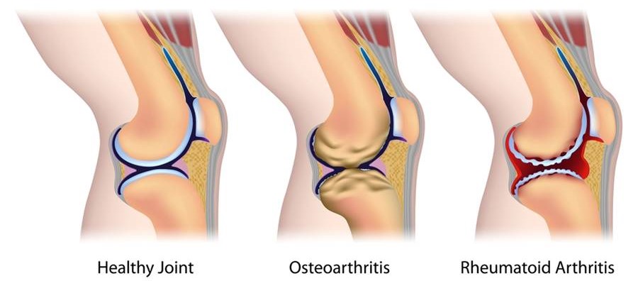 artrita progresiva a genunchiului